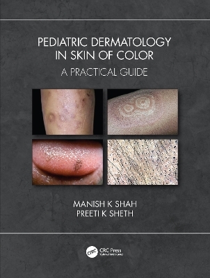 Pediatric Dermatology in Skin of Color - Manish K Shah, Preeti K Sheth