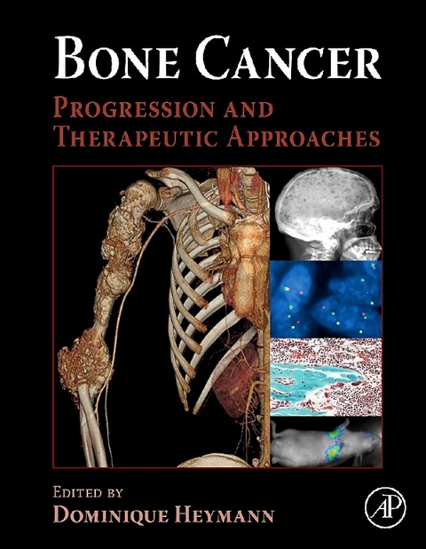 Bone Cancer - 