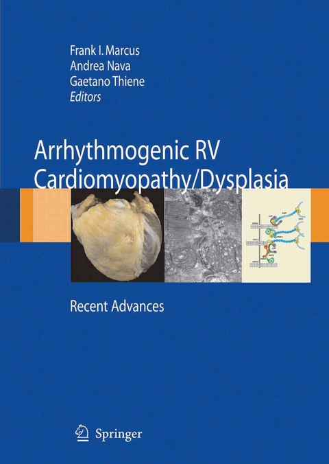 Arrhythmogenic RV Cardiomyopathy/Dysplasia - 