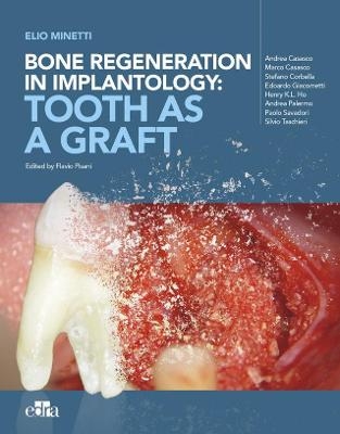 Bone regeneration in implantology - tooth as a graft - Elio Minetti, Andrea Cusasco, Marco Casasco, Stefano Corbella, Edoardo Giacometti