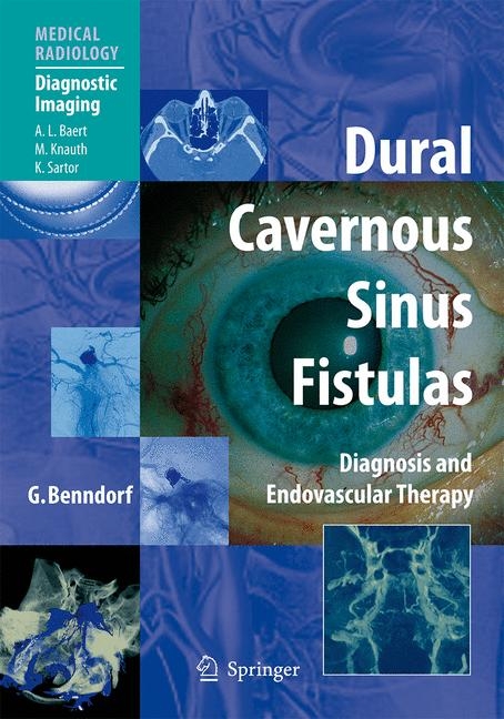 Dural Cavernous Sinus Fistulas - Goetz Benndorf