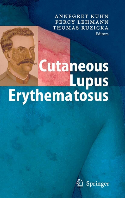 Cutaneous Lupus Erythematosus - 