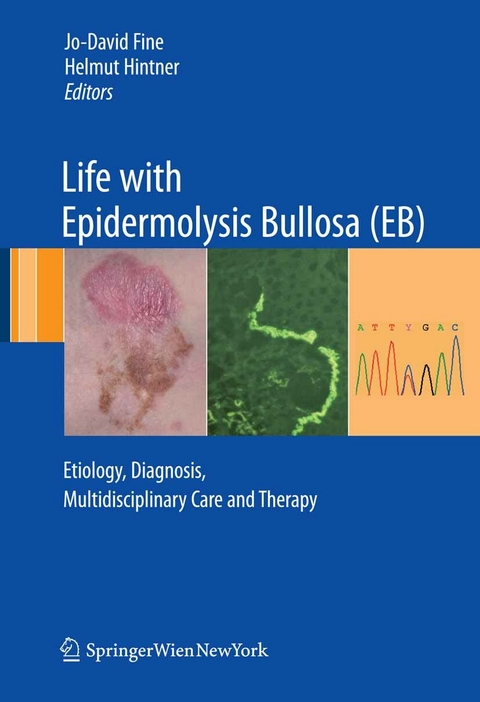 Life with Epidermolysis Bullosa (EB) - 