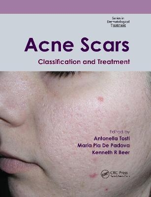 Acne Scars - 