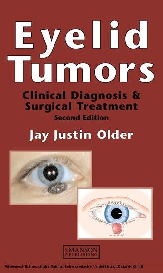 Eyelid Tumors -  Jay Justin Older