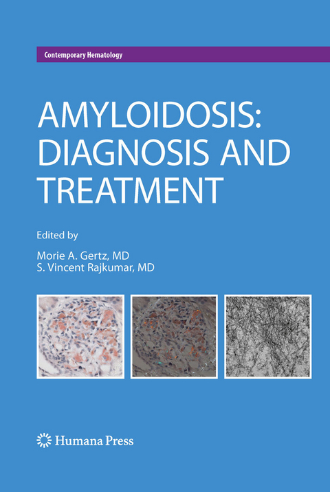 Amyloidosis - 