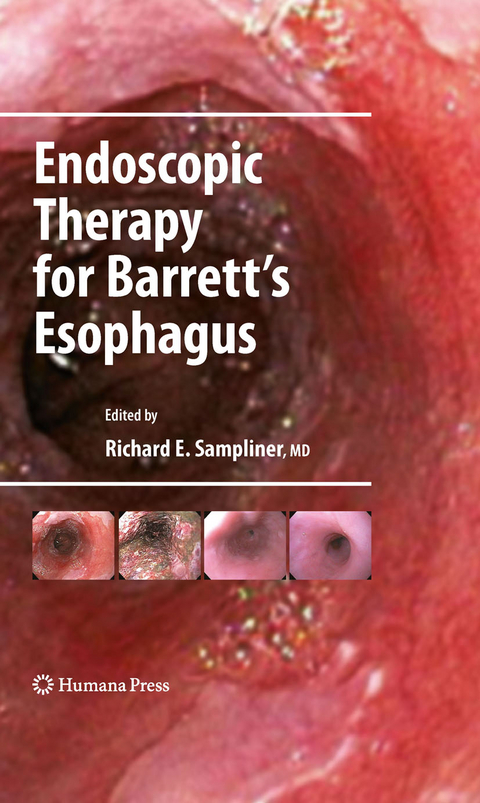 Endoscopic Therapy for Barrett's Esophagus - 