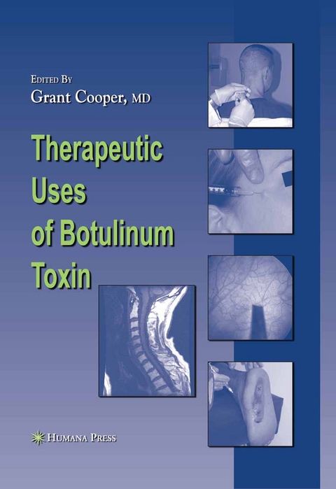 Therapeutic Uses of Botulinum Toxin - 