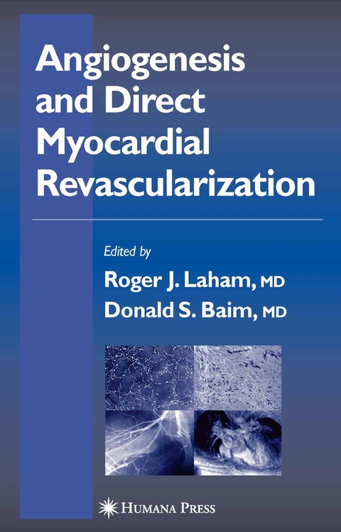 Angiogenesis and Direct Myocardial Revascularization - 