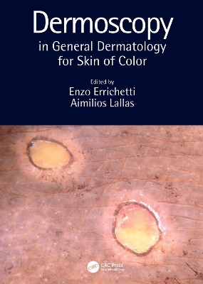 Dermoscopy in General Dermatology for Skin of Color - 