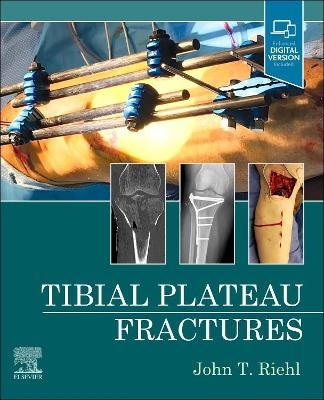 Tibial Plateau Fractures - John Riehl