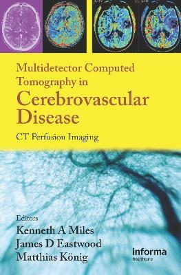 Multidetector Computed Tomography in Cerebrovascular Disease - 