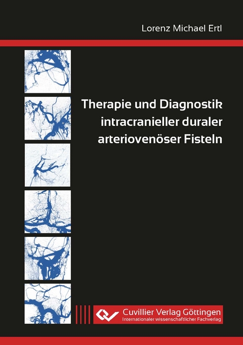 Therapie und Diagnostik intracranieller duraler arteriovenöser Fisteln - Lorenz Michael Ertl